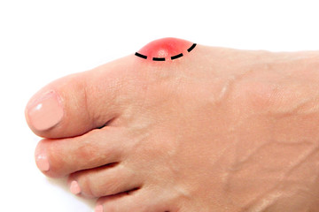 Varus valgus and Hallux valgus or bunion on middle aged woman foot. Isolated closeup on white background. Concept of treatment or cosmetology help