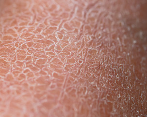 background of the texture of the skin is covered with small and large cracks and dead flaky scales