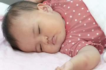 Baby girl is sleeping with illness of allergy. Baby has many red spots on face.