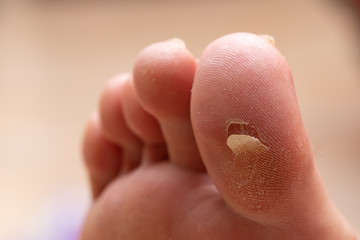 A closeup view on the foot of a person showing a callus on the hallux (big toe), dry skin peeling from under the foot of an adult.