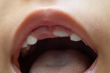 A close up view on the top lip and gum of a young child with missing front teeth. Childhood dentistry and oral health concept.