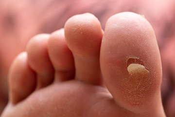 A close up view on the underside of a big toe (hallux) of a Caucasian person. A cracked and peeling callus is seen with details of the skin.
