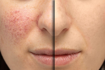 A close up view on the cheeks of a young Caucasian woman suffering from rosacea. Before and after...