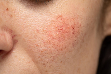 A close-up view on the cheek of a young Caucasian lady with a blotchy red cheek. A common symptom of rosacea and dermatitis in young adults. - obrazy, fototapety, plakaty