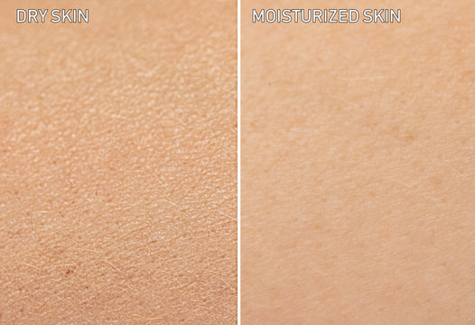 An Extreme Close Up View Of Human Skin, Before And After Moisturizer Is Applied. One Showing Dry Skin, And The Other Showing Healthy Moisturized Skin.