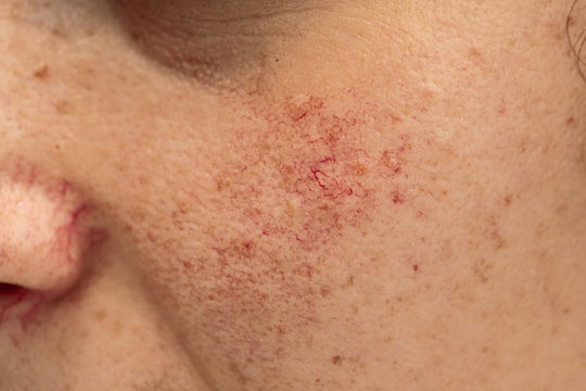 An extreme close up view on the cheek of a young Caucasian woman. Showing red blotches and pimples, symptomatic of rosacea and acneiform disorders.