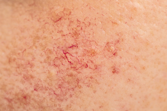 A macro view of superficial blood vessel in the cheek of a Caucasian girl suffering from contact dermatitis of the face. Copy space to the sides.