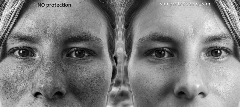 A side by side comparison of a woman who has spent time sunbathing. One side shows her with UV sun protection and the other with no protection. Results of long sun exposure on the human face.