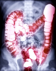 Barium enema or BE is image of large bowel after injection of barium contrast fill into colon under fluoroscopic control.