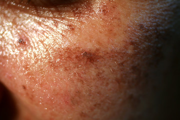 Pigmented spots on the face. Pigmentation on cheeks