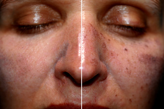 One half of the face in pigmentation and brown spots, the other side of the face after laser polishing and peeling
