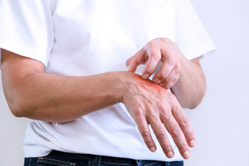 Woman Scratching an itch . Sensitive Skin, Food allergy symptoms, Irritation.