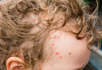 4 days old Chickenpox blisters also known as varicella on 5 year old girl head and in hair. Highly...