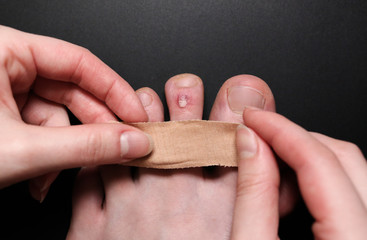 Callus blisters on feet. Man is applying antiseptic band-aid plaster on painful wounds....