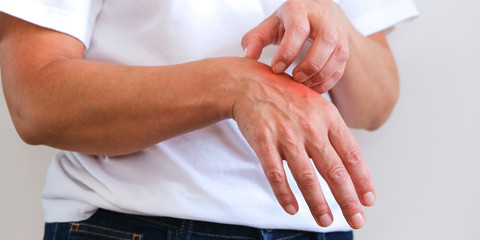 Woman Scratching an itch . Sensitive Skin, Food allergy symptoms, Irritation.