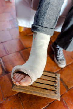 Close-up on a woman's feet in the plaster cast on a footrest in the countryside.
