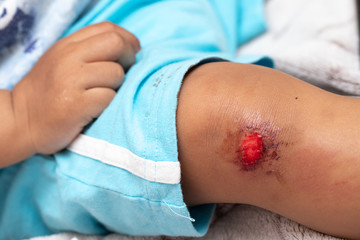 Baby with knee injury