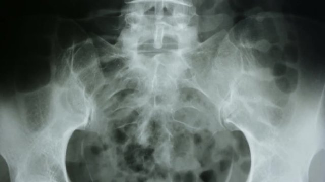 Vertical tracking shot of a radiograph of the human urinary tract, in front view.