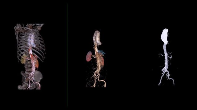 CTA abdominal aorta 3D rendering image with transparent skeletal ,3D aorta only and 3D aorta MIP   showing of aortic dissection.