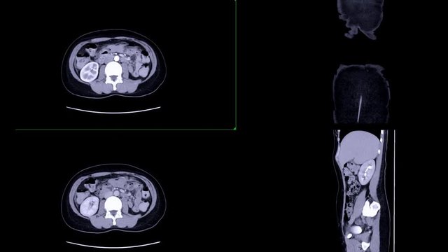 CT whole abdomen Comparison V phase and with delayed phase  Axial view and coronal,sagittal plase showing enhancement of aorta for diagnosis  disease and cancer in abdomen .
