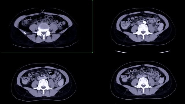 CT whole abdomen Comparison non contrast media, A phase,V phase and with delayed phase  Axial view showing enhancement of aorta for diagnosis  disease and cancer in abdomen .