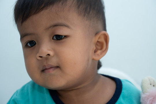 Baby has an allergic reaction to the eye,  Urticaria in food allergy patien
