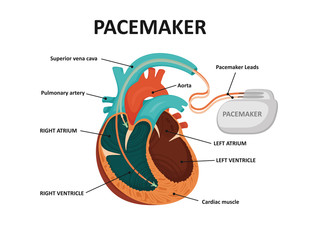 Human heart with pacemaker. Cardio implant