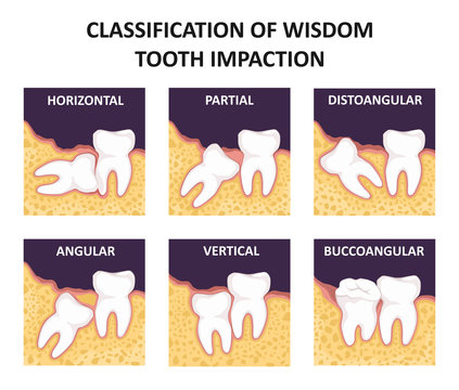 Classification of wisdom tooth impaction