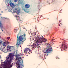 Photomicrograph of a Papanicolaou (Pap) test ("smear", stain)  showing  yeast and pseudohyphae of Candida albicans, a type of fungus. 