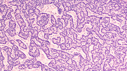 Microscopic image showing histology of a parathyroid adenoma, a benign tumor which releases...