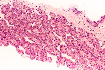 Liver cancer awareness, core biopsy: Photomicrograph of hepatocellular carcinoma (hepatoma), a malignant tumor often associated with chronic hepatitis B. 