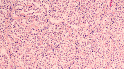 Testicular Cancer: Photomicrograph of seminoma, a malignant germ cell tumor of the testis...