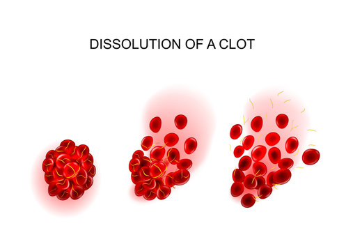 dissolution of the clot. thrombolysis