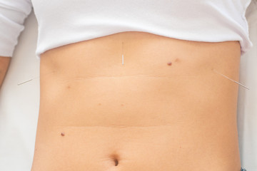 Acupuncture needles in the belly