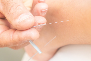Obraz na płótnie Canvas Acupuncture needles on the legs and foot