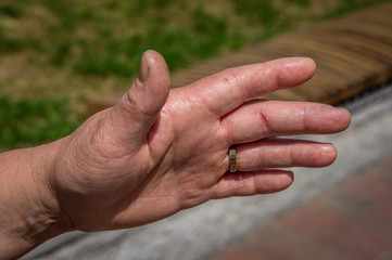 Hand Mature women. Wound on finger