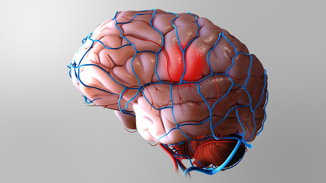 3D Brain Stroke Illustration