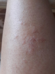 Fototapeta premium Skin diseases