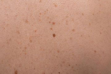 Fototapeta premium An extreme closeup view of moles, freckles and pimples on Caucasian skin filling the frame. Skin cancer and dermatology concepts.