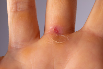 An extreme close up view of a sore and bleeding callus on the palm of a Caucasian hand. Fresh wound...