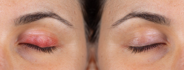 Macro of a woman's eye with swollen and inflamed eyelid, symptoms of blepharitis