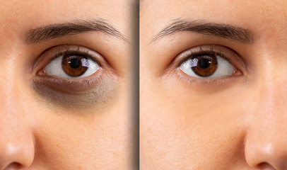 A close up before and after shot on a young woman with a black and bruised eye. Image on the right shows healing of the delicate skin beneath the eye. Domestic violence concept.