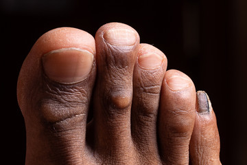 A closeup view on the foot of an adult human showing callused toes and tinea unguium in the nail of...