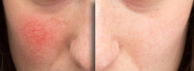 A before and after view of rosacea treatment. Young Caucasian woman shows results of laser surgery...