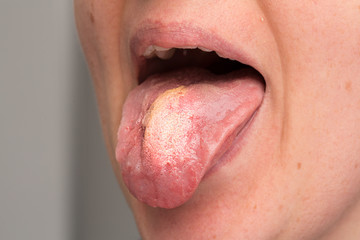 A young Caucasian woman sticks her tongue out to reveal a candida albicans yeast infection, the...