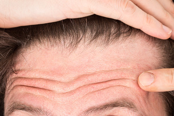 A closeup view on the forehead of a thirty something Caucasian man. Pointing towards open pores and...