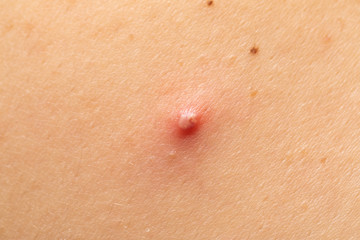 Red pimple on human skin