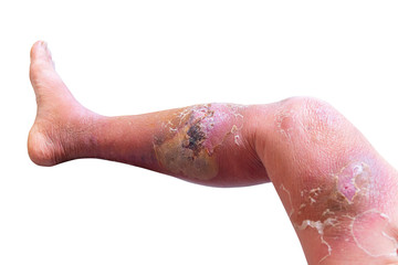 Erysipelas bacterial infection Under the skin leg aged people On  white background
