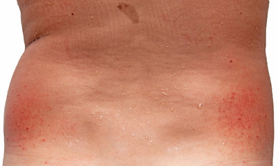 allergic rash on the skin of the back