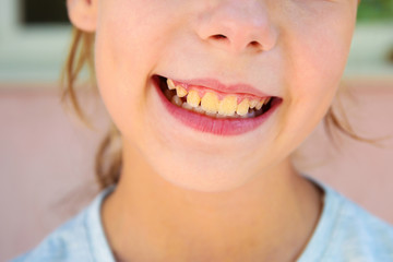 Dental plaque in teenager.